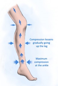 Illustration how graduated compression is applied to the leg