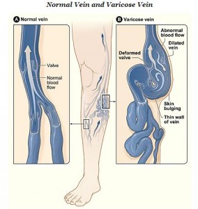 Illustration of normal veins compared to varicose veins